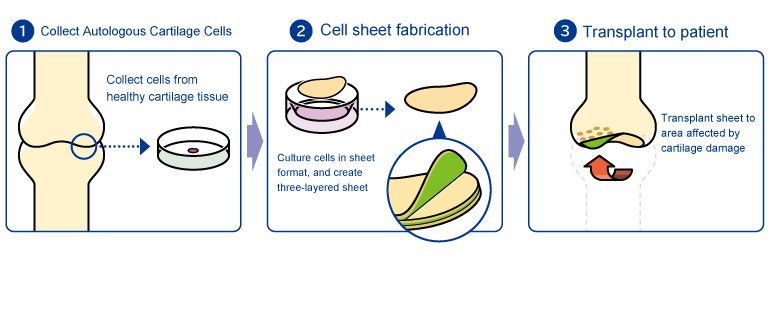 Autologous Chondrocyte Sheet