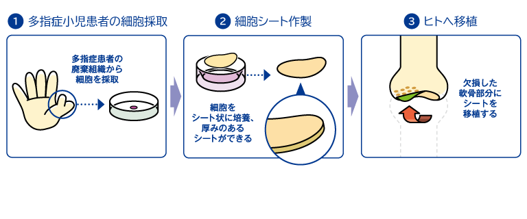 同種軟骨細胞シート