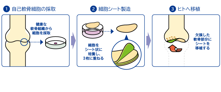 自己軟骨細胞シート